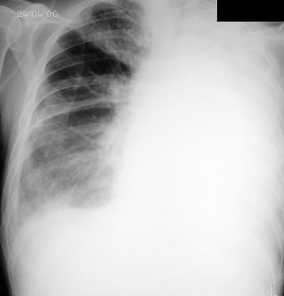 Chest X ray (+87 days)