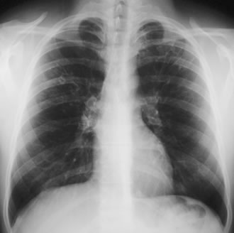 Patient CF 30 yrs with cystic fibrosis developed ABPA. - Aspergillus ...