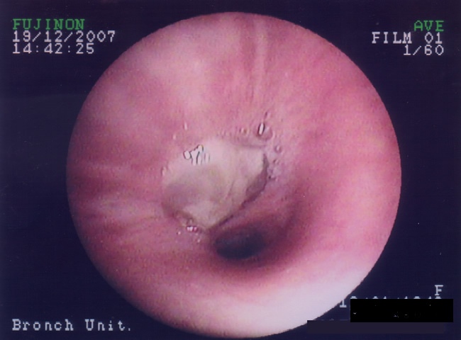 Patient VE - Plugging of airways with mucus 1