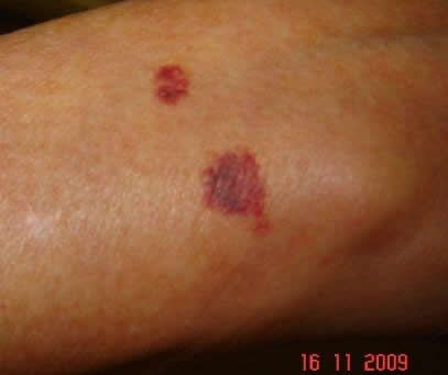 ecchymosis on arms