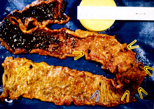 intestinal 3