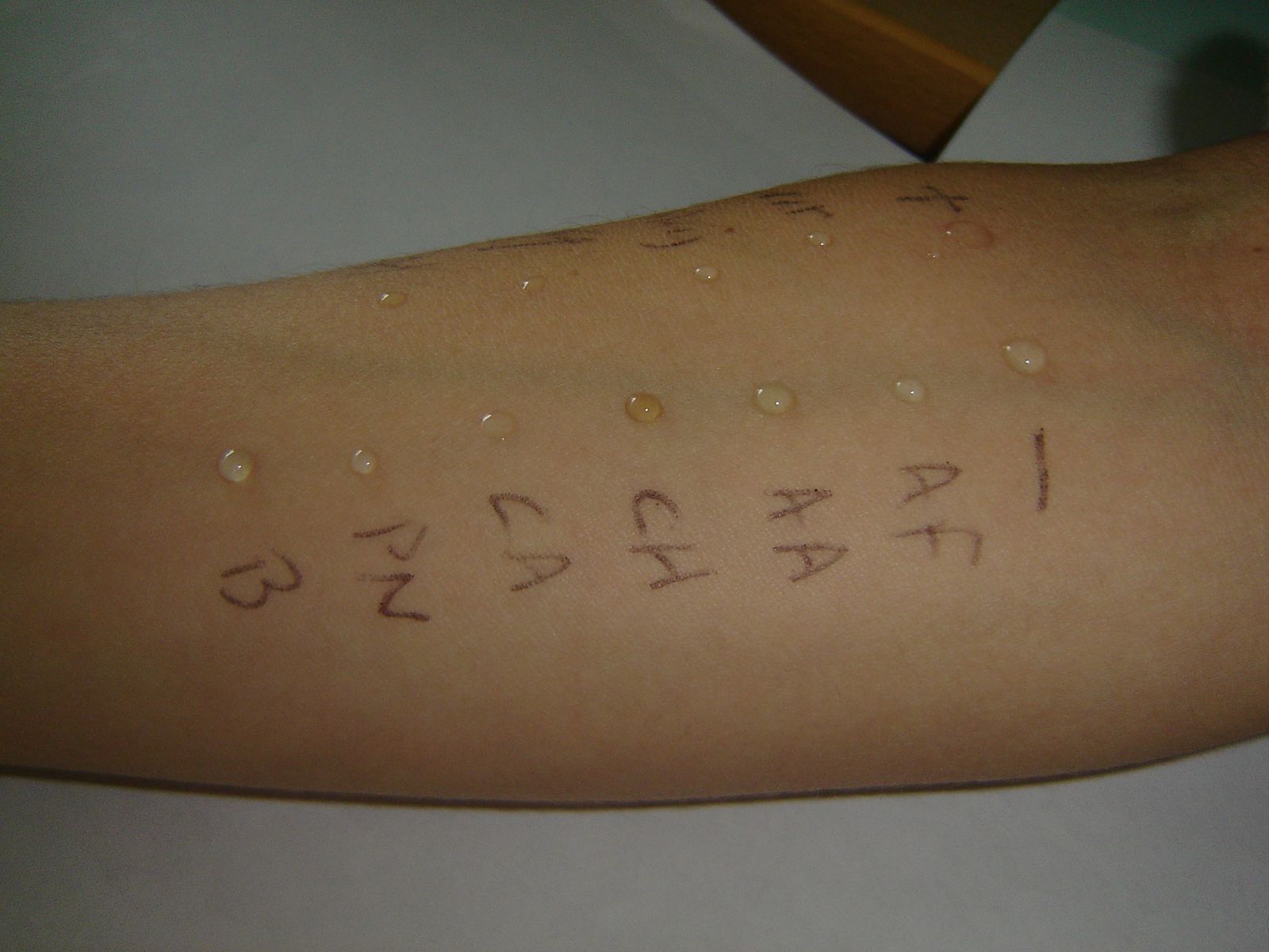 Skin testing for fungal allergy Aspergillus and Aspergillosis