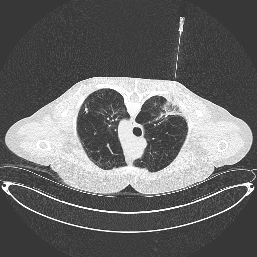 Percutaneous biopsy needle is seen vertically above the back