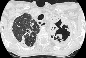 Chronic cavitary pulmonary aspergillosis