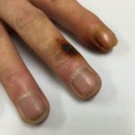 Nicotine stained fingers - image 1