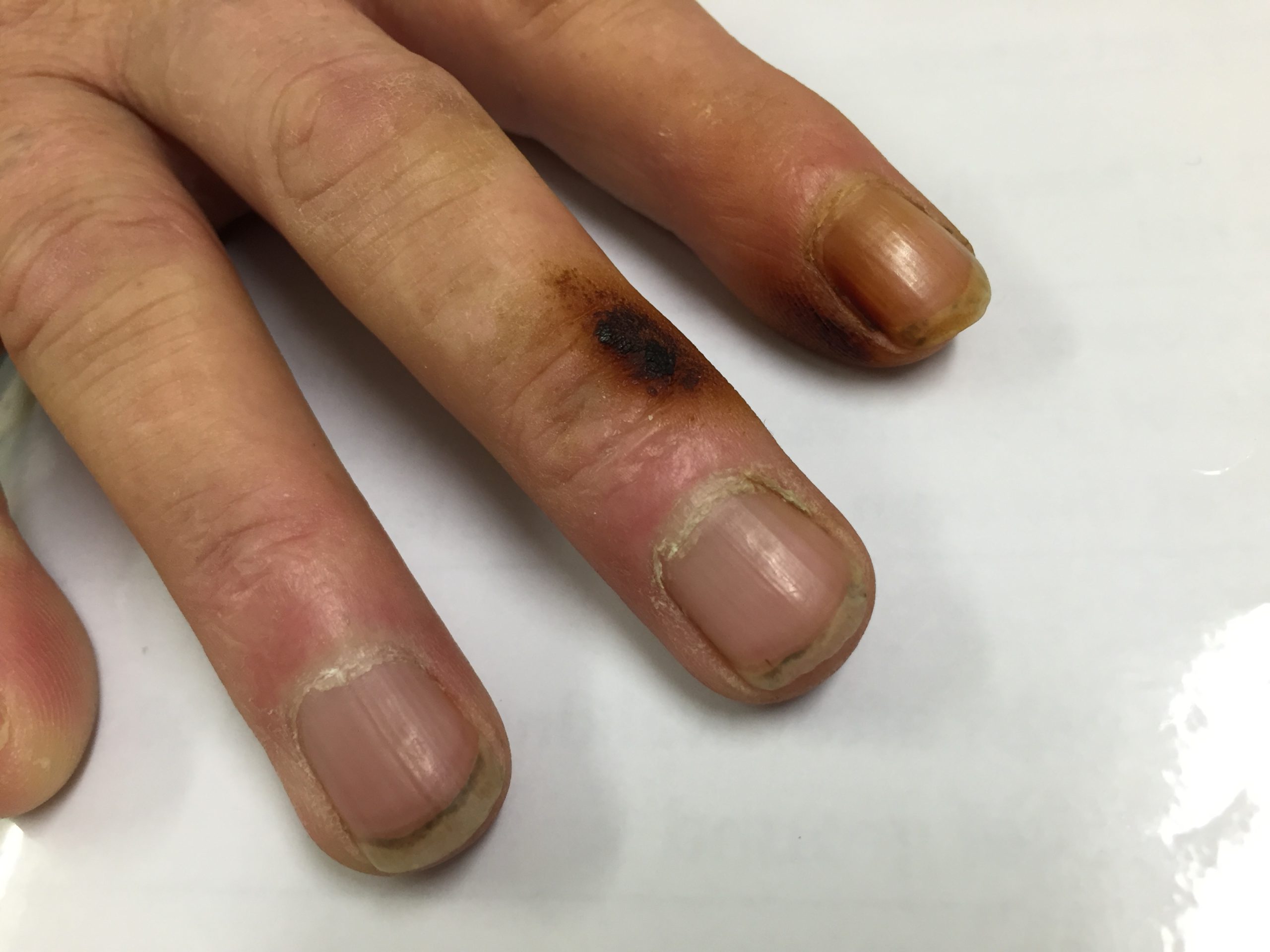 How To Remove Nicotine Stains From Fingernails Paradox