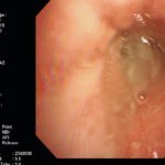 Patient YML ABPA and mucoid impaction Image 2