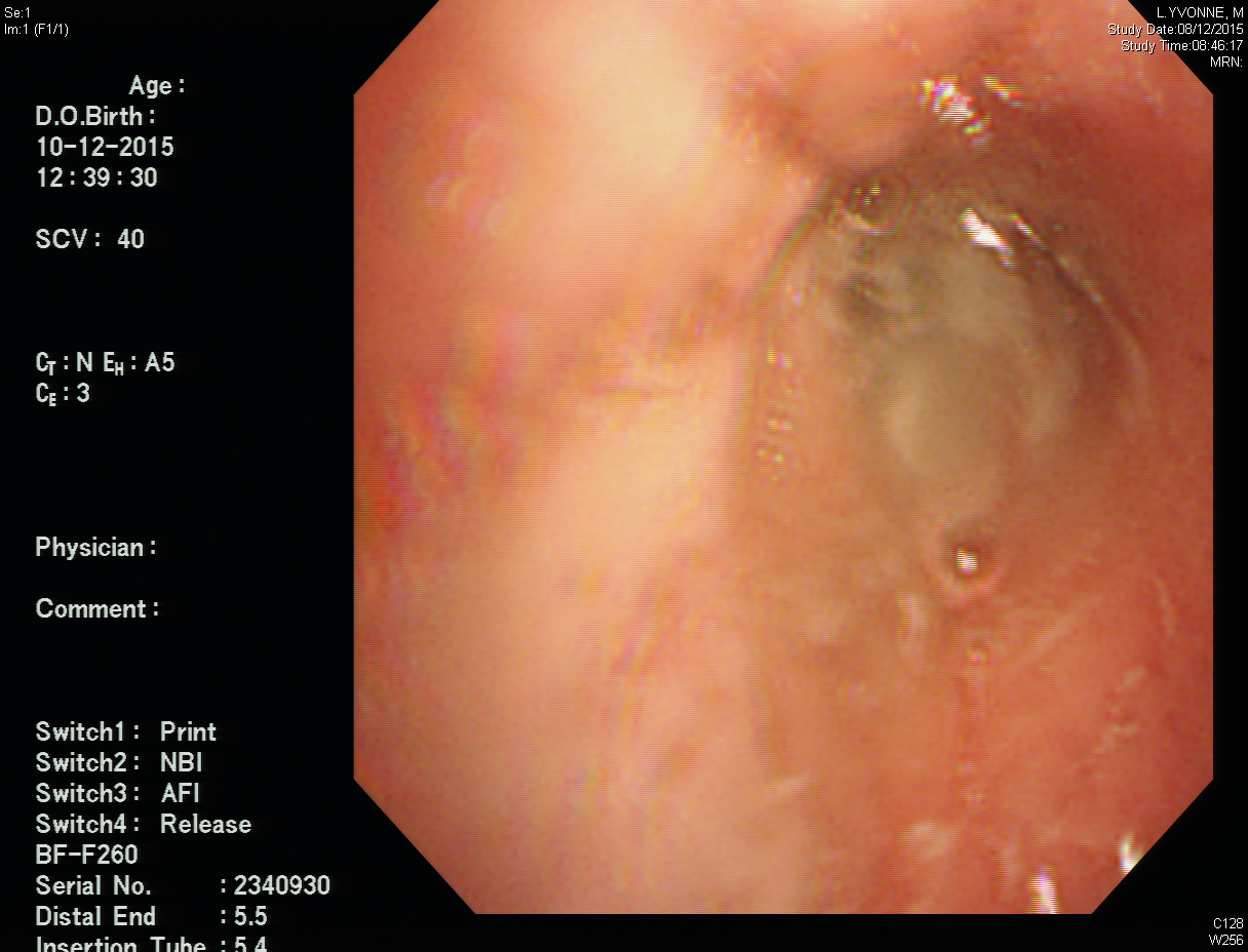 Patient YML ABPA and mucoid impaction Image 2