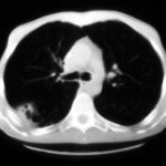 After 3 months therapy with itraconazole, there was little change in the original lesion seen here on a CT scan of the thorax.