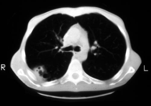 Acute Invasive Pulmonary Aspergillosis In AIDS, Pt RP - Aspergillus And ...