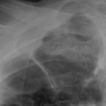 Image B. Chest xray 7/1/05 Close up of cavity in upper right lobe 