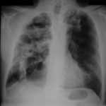 Image G. Chest xray 22/9/06