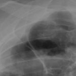 Image H. Chest xray 22/9/06 Close up of upper right cavity