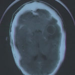 Brain abscess 1