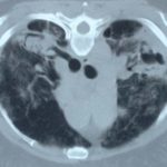 Image B. Sarcoidosis with 2 cavities containing aspergilloma patient DB