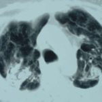 Image C. Progession of aspergilloma (?CIPA) in sarcoidosis, patient DB.