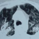 Image D. Progession of aspergilloma (?CIPA) in sarcoidosis, patient DB.