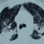 Image E. Progession of aspergilloma (?CIPA) in sarcoidosis, patient DB.