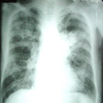 Chest X-ray 10 days prior to admission 
