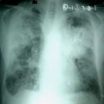 Chest x ray of patient 4 days prior to admission