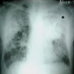 Chest X ray on admission 