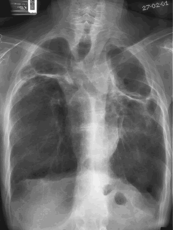 Chest X Ray 27/02/01