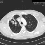 Image 5 27/05/09 CT scan confirmed the presence of several cavities and a fungal ball of 24mm in a 5cm diameter cavity. Some thickening and distortion of bronchi was noted. Pleural thickening peripheral to the cavity was seen.