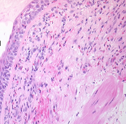 Image H. Bronchial mucosa under H & E stain showing numerous eosinophils deep to the mucosa, and mucus in the lumen of the bronchiole.