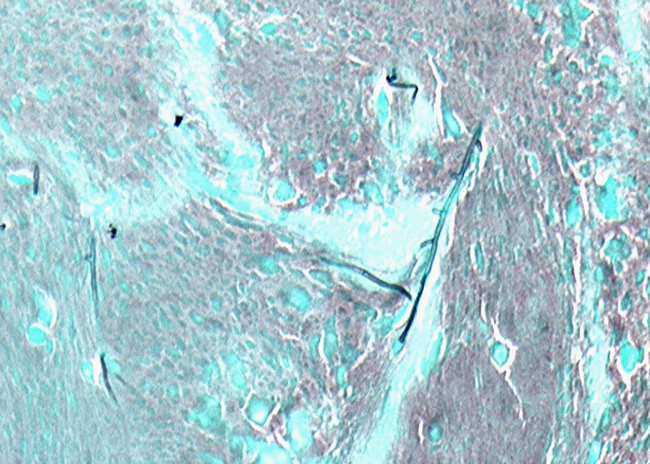 Image I. Grocott (silver) stain showing branching septate hyphae fairly typical of Aspergillus in mucus. The apparent right angle branching is unusual (Low power mag.).