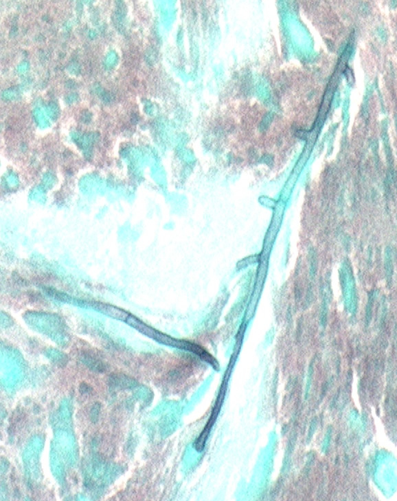 Image J. Grocott (silver) stain showing branching septate hyphae fairly typical of Aspergillus in mucus. The apparent right angle branching is unusual (High power mag.)..