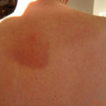 Image D: Papular rash with blisters on the back, associated with CPA but prior to treatment, rash appeared 2 years previously in October 2007. The rash resolved on treatment with azoles.