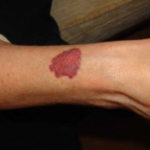 Image A: Red skin rash on arms due to effect of inhaled steroids termed ecchymosis.