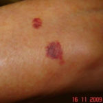Image B: Red skin rash on arms due to effect of inhaled steroids termed ecchymosis.
