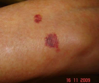 Image B: Red skin rash on arms due to effect of inhaled steroids termed ecchymosis.