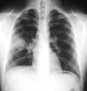 Image B. 29/9/99 FEV1 = 1.6. IgE=3000 RAST=52.5. Rx  atypical pneumonia (FEV1=3.3 post antibiotics) 