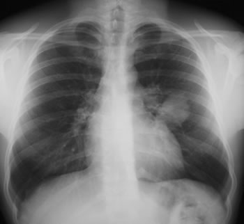 Image D.19/03/02 FEV1=3.4.IgE=2220 RAST=36 Rx antibiotics 