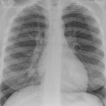Image E. Chest X ray 1 (cf CT scan 1) one week pre-admission