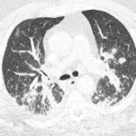 Image B. CT scan 2, on admission