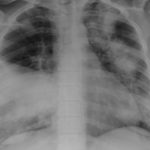 Image F. Chest X-ray 2 (cf CT Scan 2) on admission