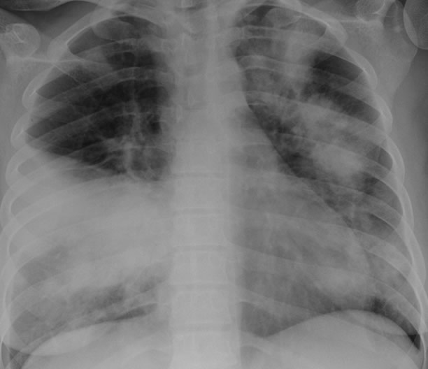 Pt DG pseudomembranous aspergillus tracheobronchitis - Aspergillus and ...