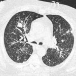 Image C. CT scan 3: Following 6 weeks antifungal treatment