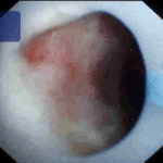 Image I. Bronchoscopy one week after admission- improvement, with some clear areas with no secretions, less oedema than one week earlier (not shown).