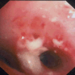 Image J. Bronchoscopy 2 weeks after admission, much improved  only local plaques in distal airways.