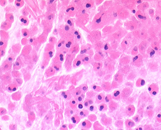 Image G. Sheets of eosinophils 