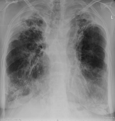 This chest radiograph shows widespread bronchiectatic with numerous small cavities at both apices of the lungs, with overlying pleural thickening and also additional changes at both bases. The transformation from ABPA is occasionally seen after many years of ABPA.