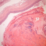 Image C. Low power microscopic view, haematoxylin and eosin staining, of obstructed bronchus with typical ‘laminated’ appearance – alternating layers of mucus and inflammatory cells.