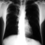 Recurrent pulmonary shadows 2, pt BJ. 