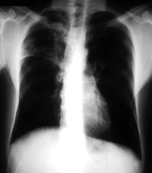 Recurrent pulmonary shadows 2, pt BJ. 