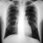 Clearing of pulmonary shadows 3, pt BJ.