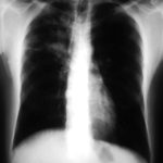 Recurrence of pulmonary shadows 4, pt BJ.